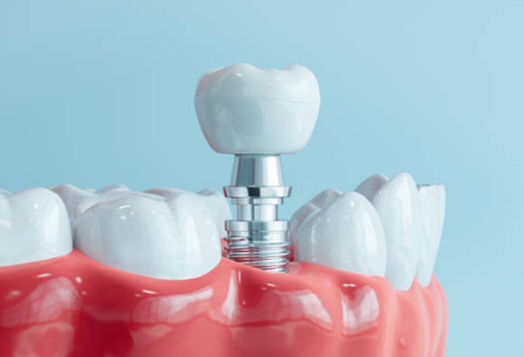 Dental Implants in Malaysia: Are They Worth the Cost?