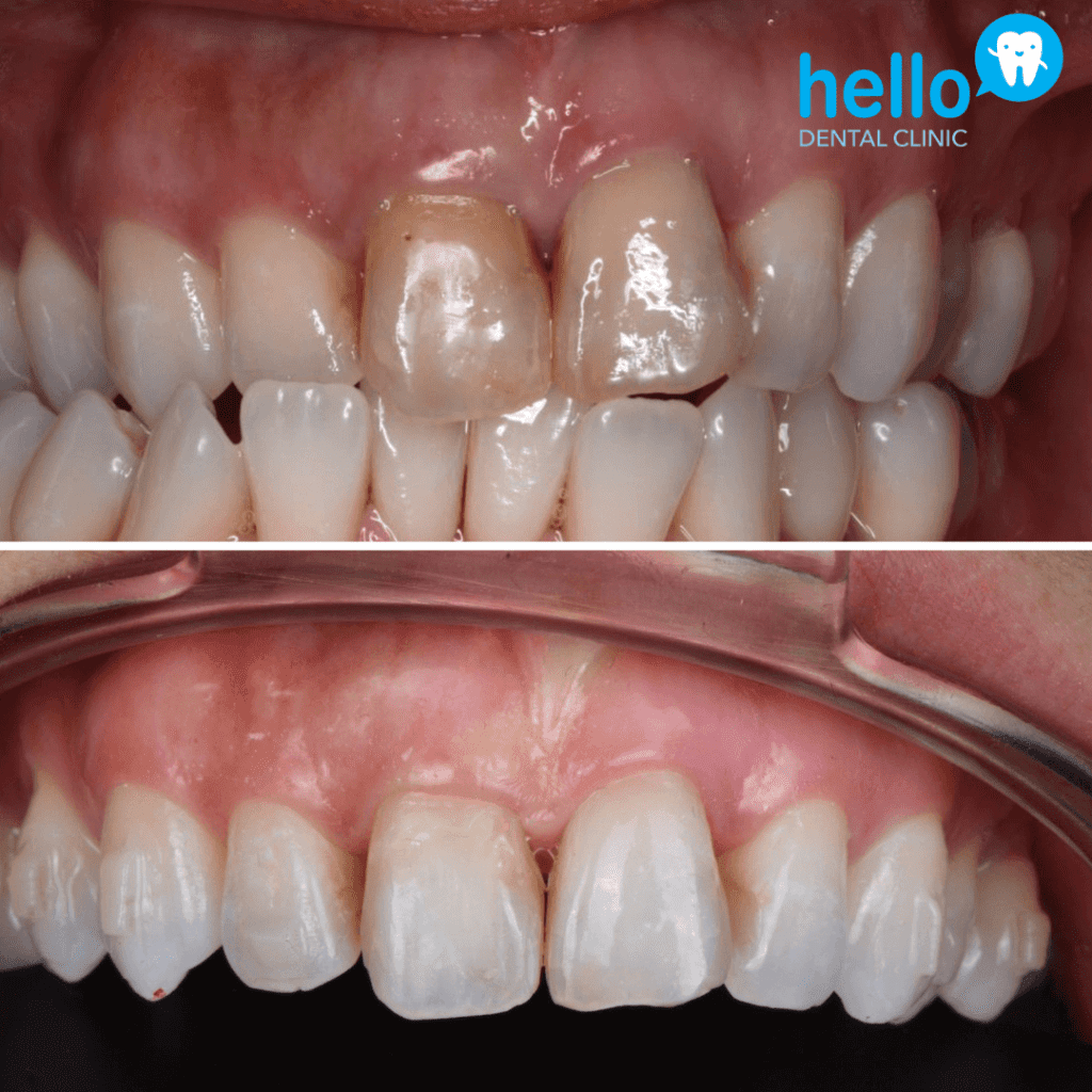 natural teeth whitening results